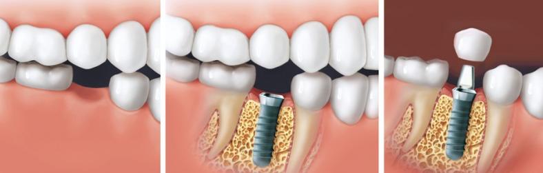 Comment se déroule la chirurgie dentaire ?